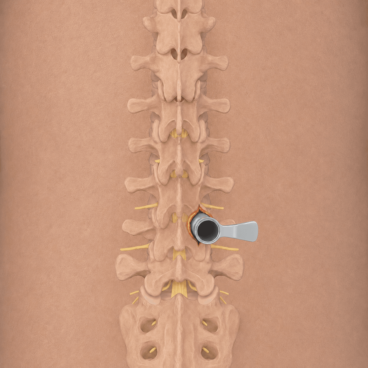Medical illustration of minimally invasive spine surgery using a tubular retractor