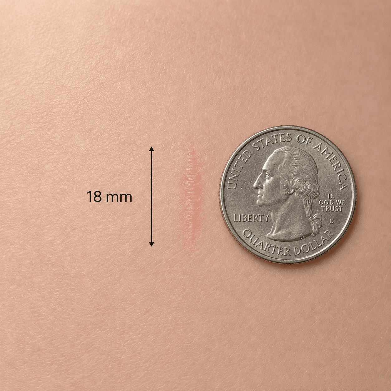 Healed surgical incision measuring 18 mm, shown next to a dime for scale