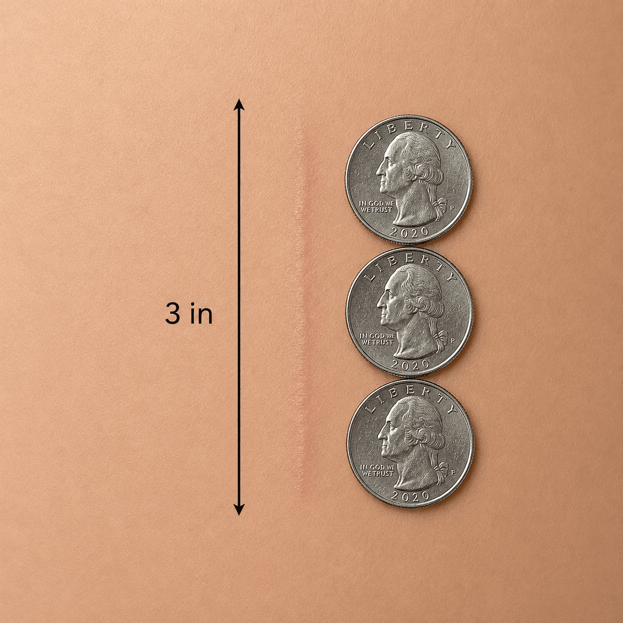 Healed surgical incision measuring 3 inches, shown next to stacked dimes for scale
